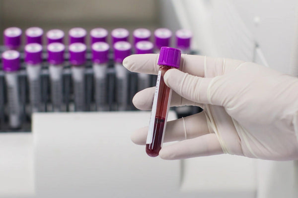 Alzheimer-kór kockázati teszt - p-tau181 biomarker